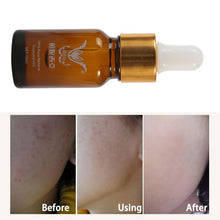 10ml Essence full-body whitening chicken skin repair essential oils remove dead skin goose bumps pimples folliculitis